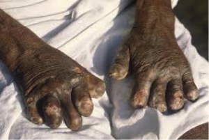 Leper's hands